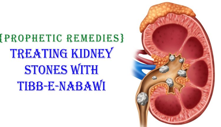 Kidney Stone with Tibb-e-Nabawi